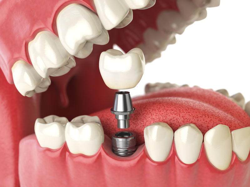 Implanty zębów Łask
